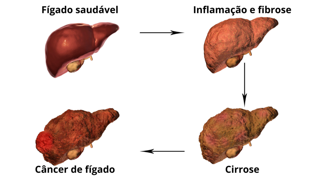 Gordura no fígado: causas, sintomas, riscos e como tratar de forma natural